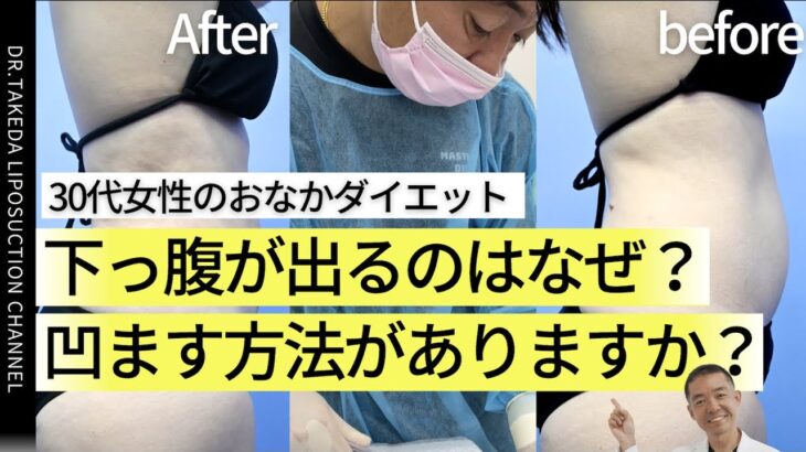 【30代女性のおなかダイエット】下っ腹が出るのはなぜ？凹ます方法があります！【根こそぎ先生の脂肪吸引】