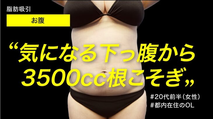 【23歳/154cm/62kg/BMI27】脂肪吸引で気になる下っ腹を即効ダイエット【3500cc根こそぎました】