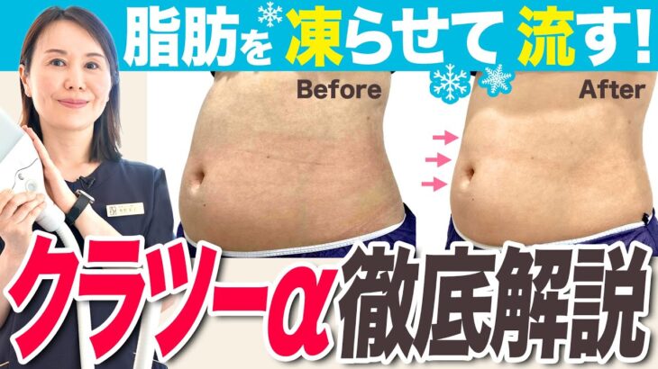 【脂肪冷却痩身】メスを使わず部分痩せ！クラツーα徹底解説